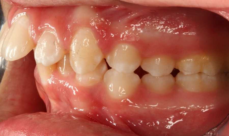 שיניים בולטות