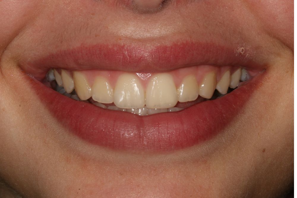 שיניים בולטות - אחרי הטיפול ליישור שיניים