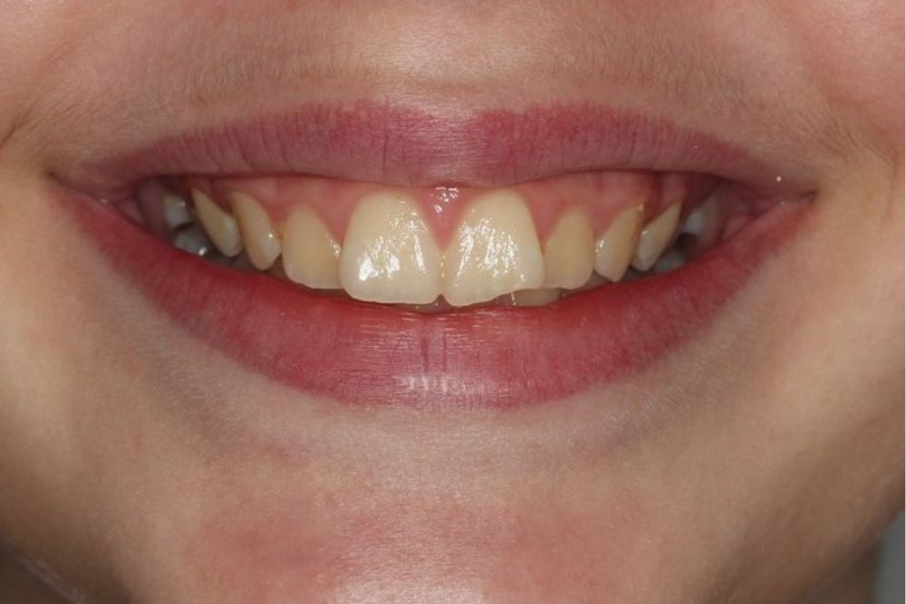 שיניים בולטות - לפני הטיפול ליישור שיניים