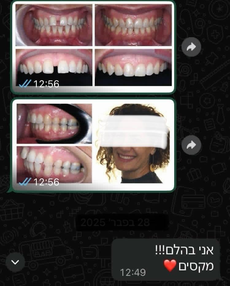סגירת רווחים בשיניים לפני ואחרי טיפול אורתודונטי מתקדמת על ידי ד"ר שרית בן שמן
