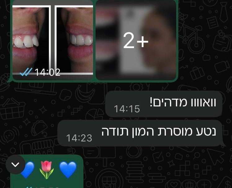 תיקון שיניים בולטות ומנשך פרופיל לפני ואחרי יישור שיניים שקוף אצל נטע
