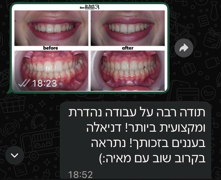 תוצאות לפני ואחרי יישור שיניים אצל ילדים ונוער ד"ר שרית בן שמן והמלצה מאמא של דניאלה